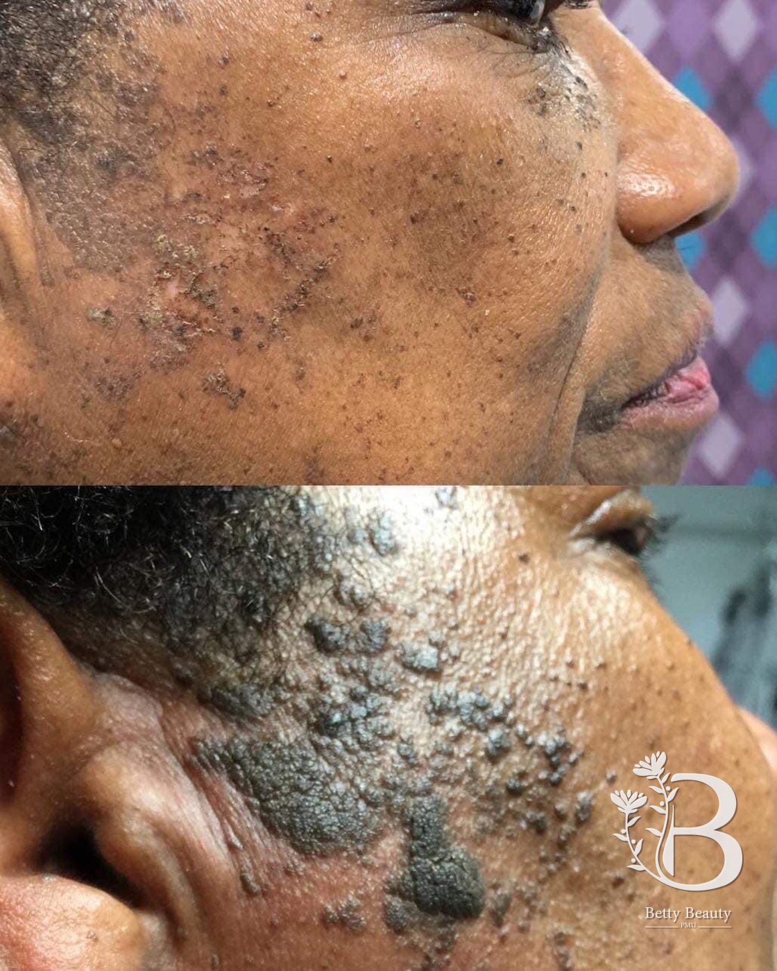 Fibroblast skin treatment, before and after