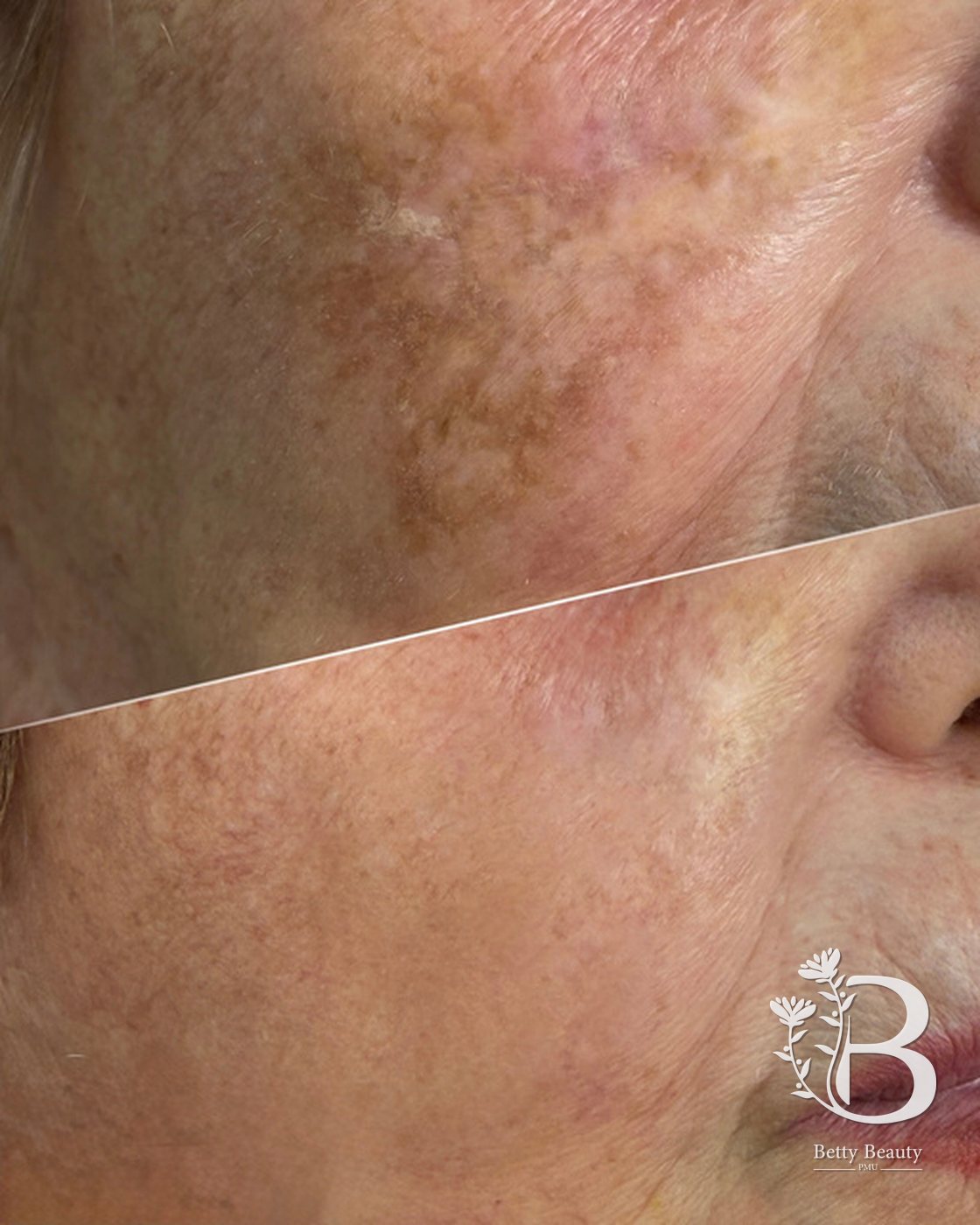 Facial pigmentation correction, before and after