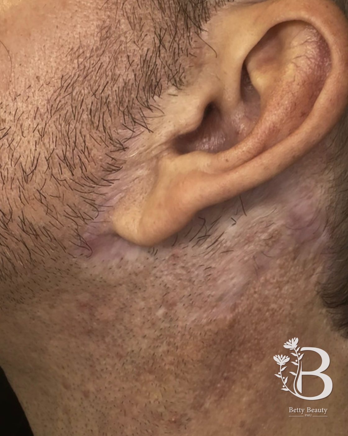 Healed scar camouflage along the beard line