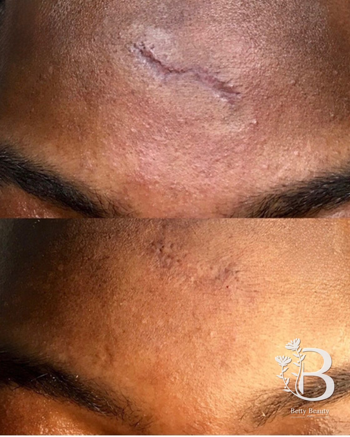 Forehead scar camouflage, before and after