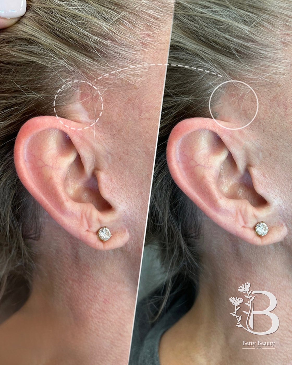Scar camouflage at the hairline, before and after