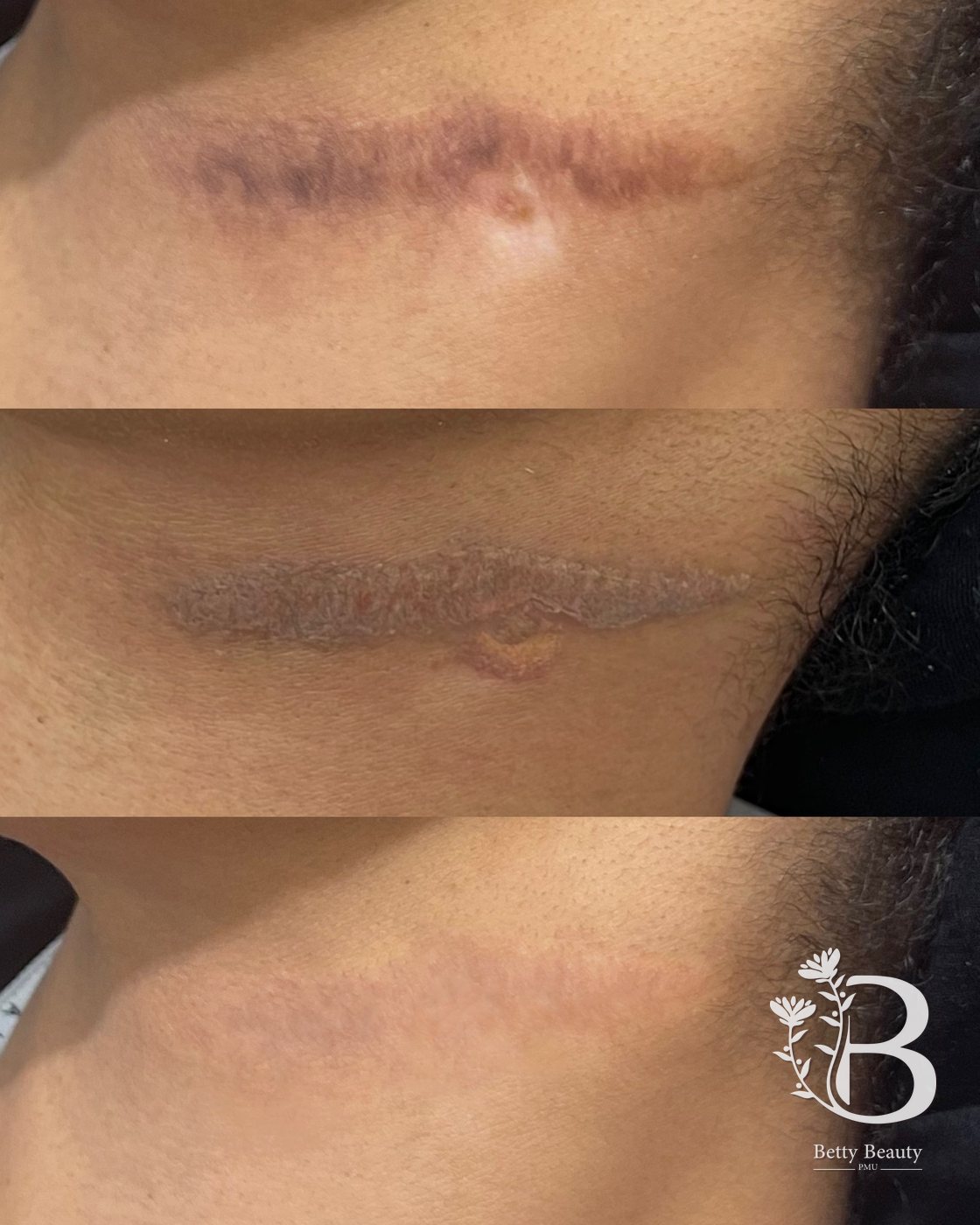 Neck scar camouflage, sessions and healed result