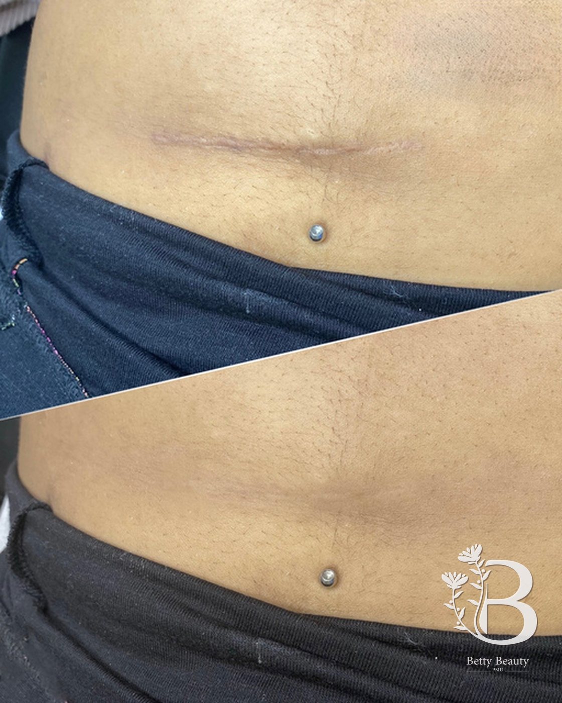 Stomach scar camouflage, before and after