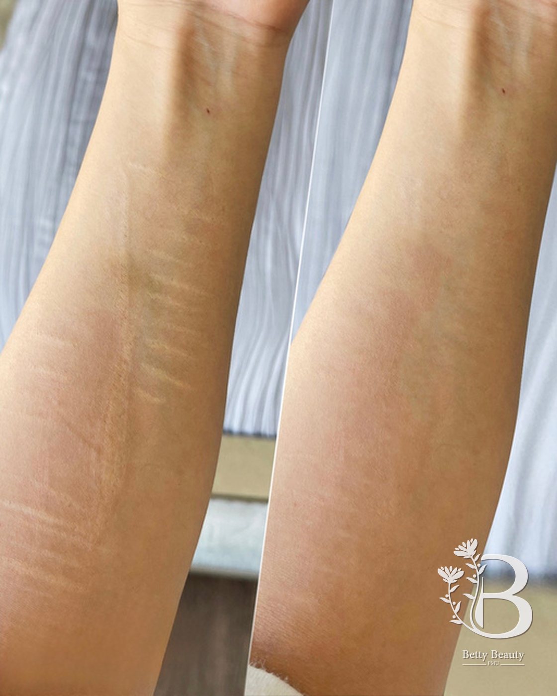 Inkless stretch mark revision on an arm, before and after