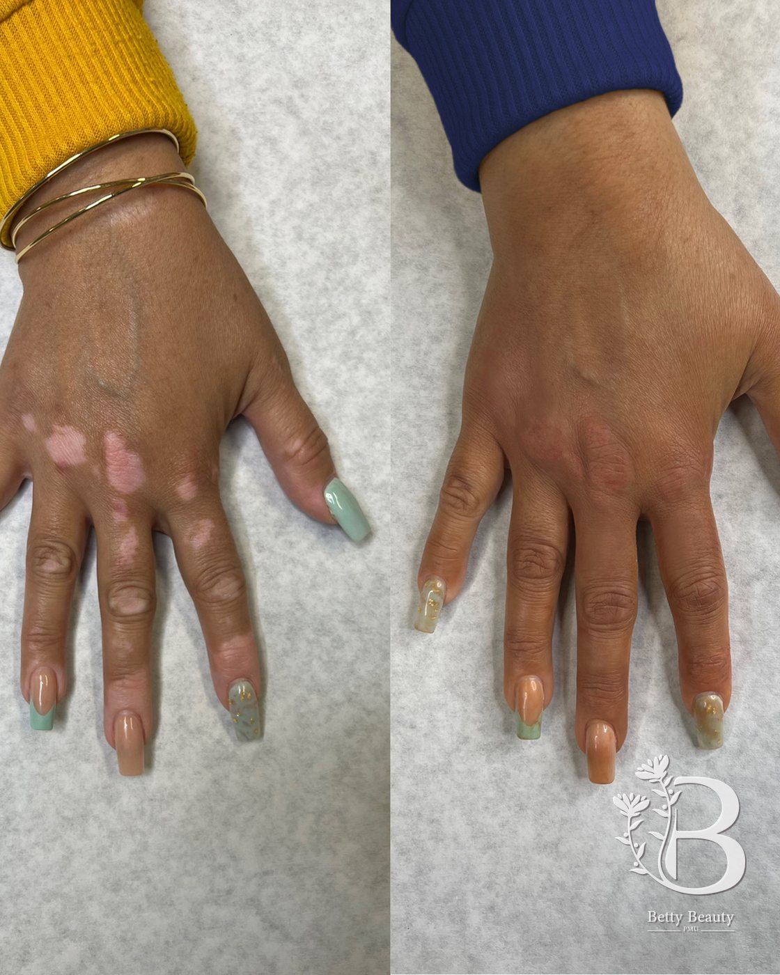 Vitiligo camouflage on a hand, before and after